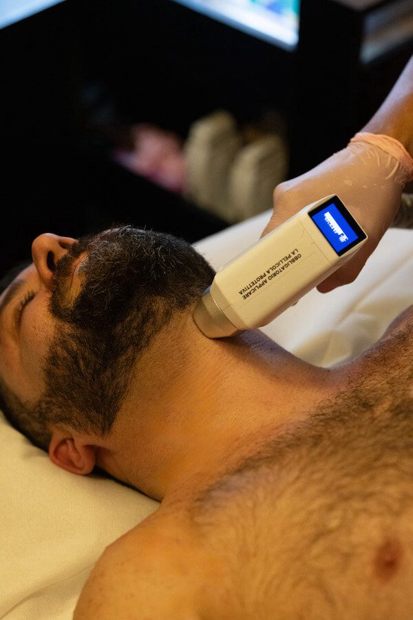 epilazione laser barba